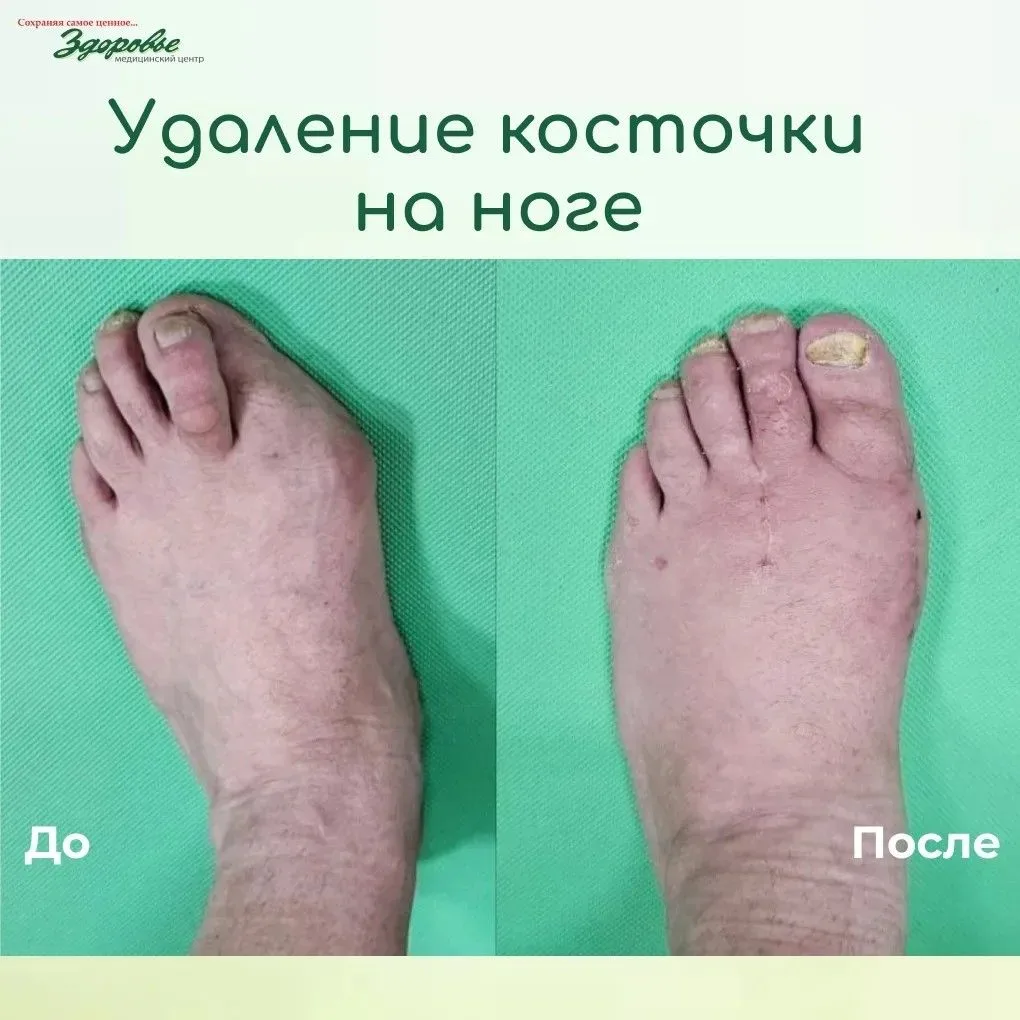 КОСТОЧКА У БОЛЬШОГО ПАЛЬЦА — НЕ КОСМЕТИЧЕСКАЯ ПРОБЛЕМА, А ВАЛЬГУСНАЯ ДЕФОРМАЦИЯ СТОПЫ.
