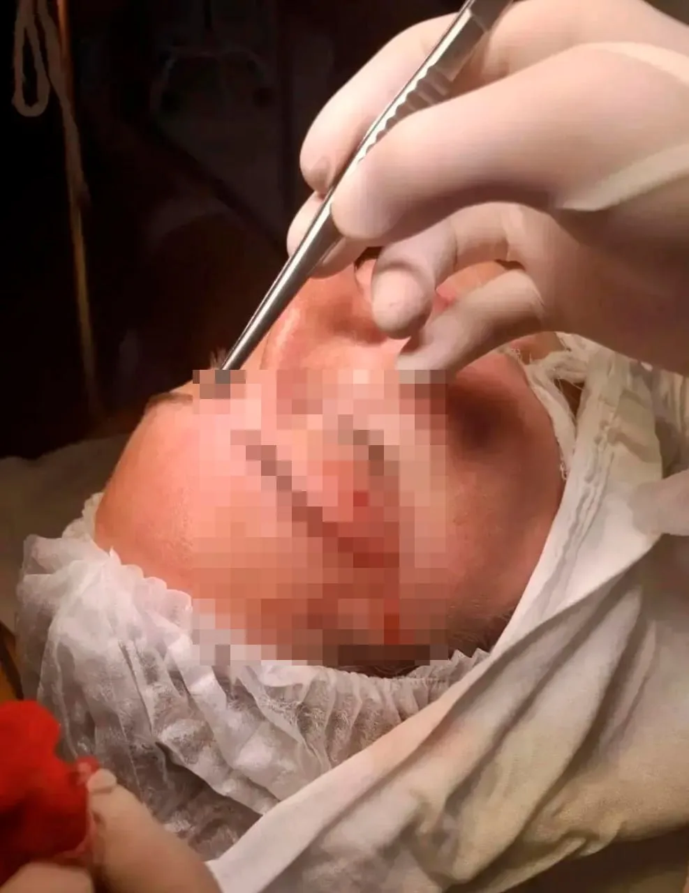 🪱 Врачи извлекли живого червя из-под века девушки