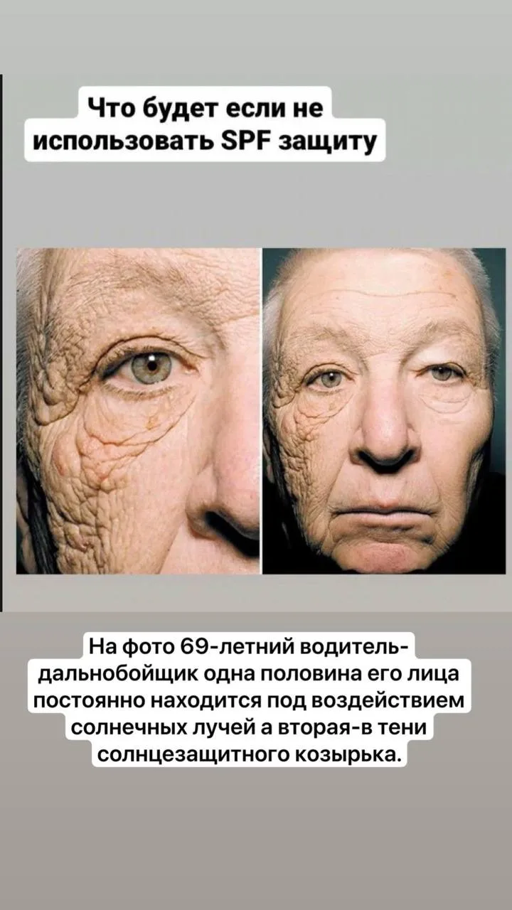 Фотография дальнобойщика, у которого очень дряблая кожа на левой половине лица, и она выглядит на де