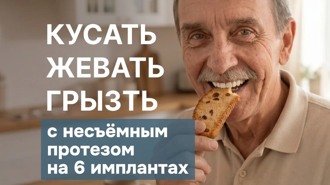 Имплантация зубов в Москве: на 4-х или 6-ти имплантах?