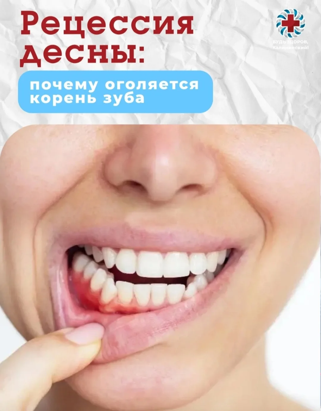 Рецессия десны: почему оголяется корень зуба