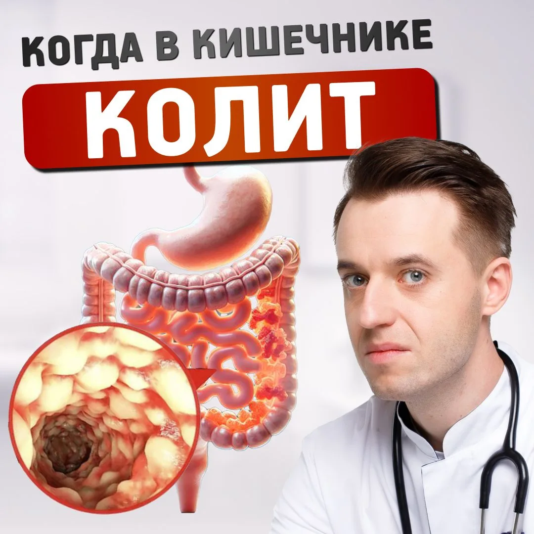 Молодой человек пришел: боль в животе, частый стул. "Наверное, обычный колит, что-то не то съел". На