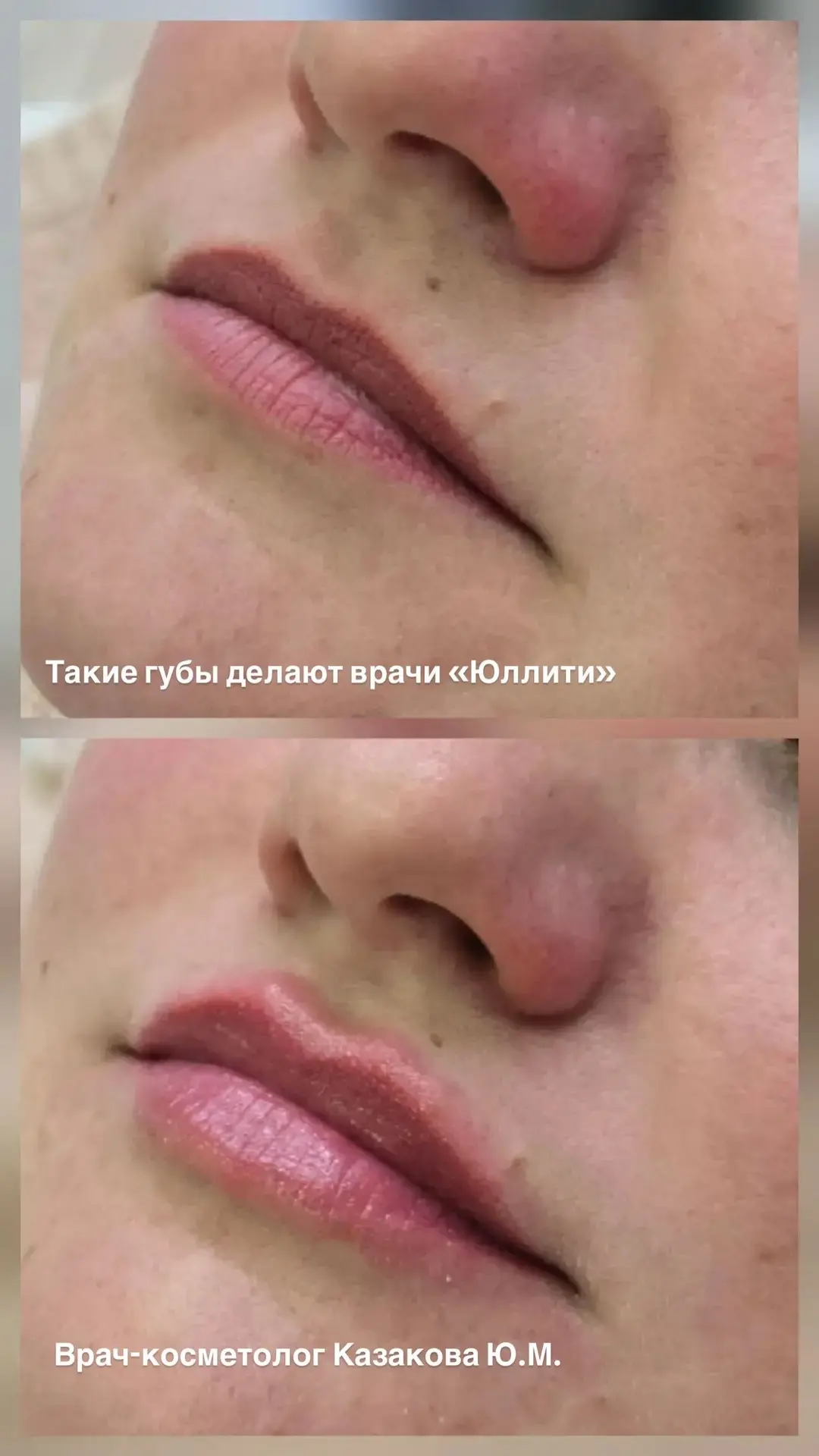 Если хотите красивый результат с первого раза, делайте контурную пластику губ в клинике с медицинско