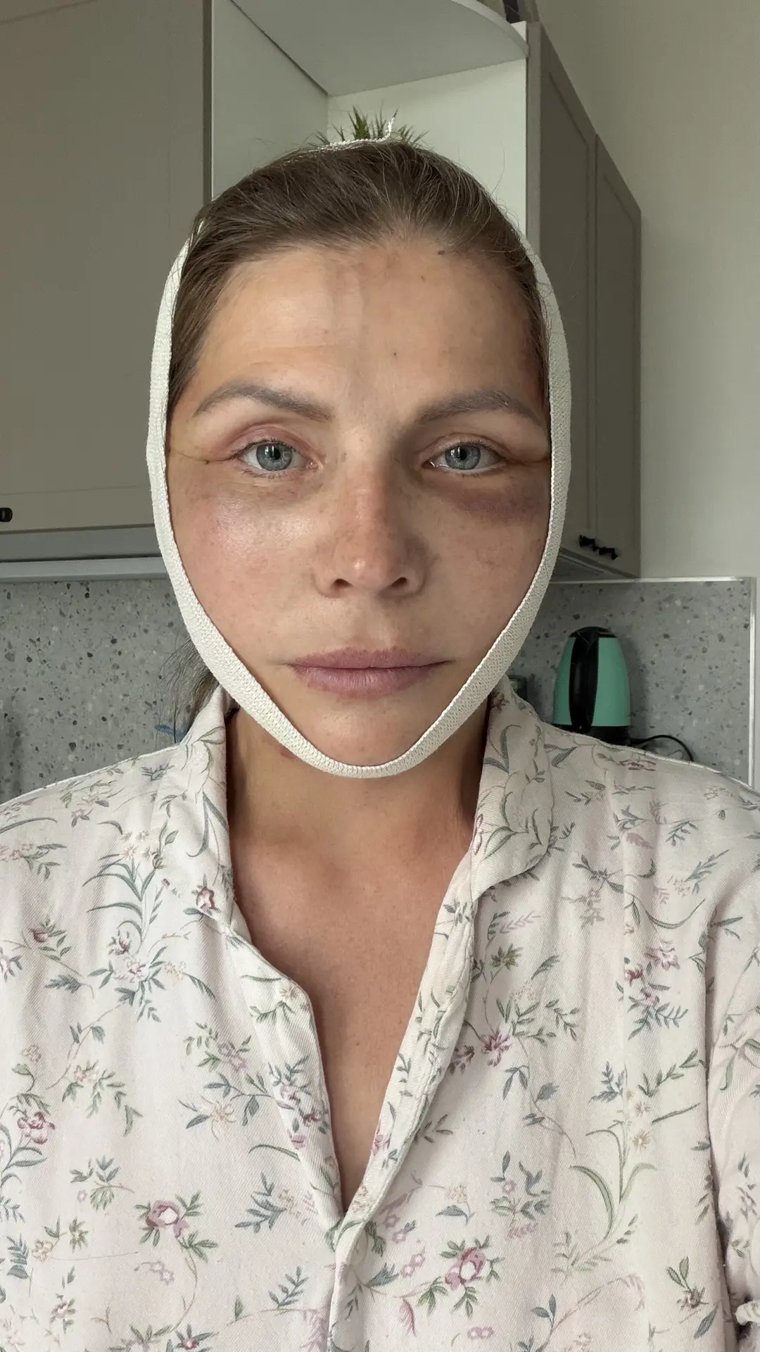 Ну что, я немного потерялась. Сегодня второй день после операции. Если сравнивать блефа...
