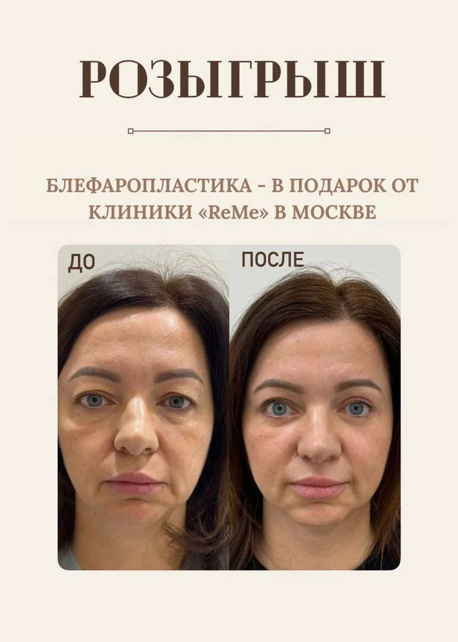 Дарим блефаропластику одной из вас 💋
