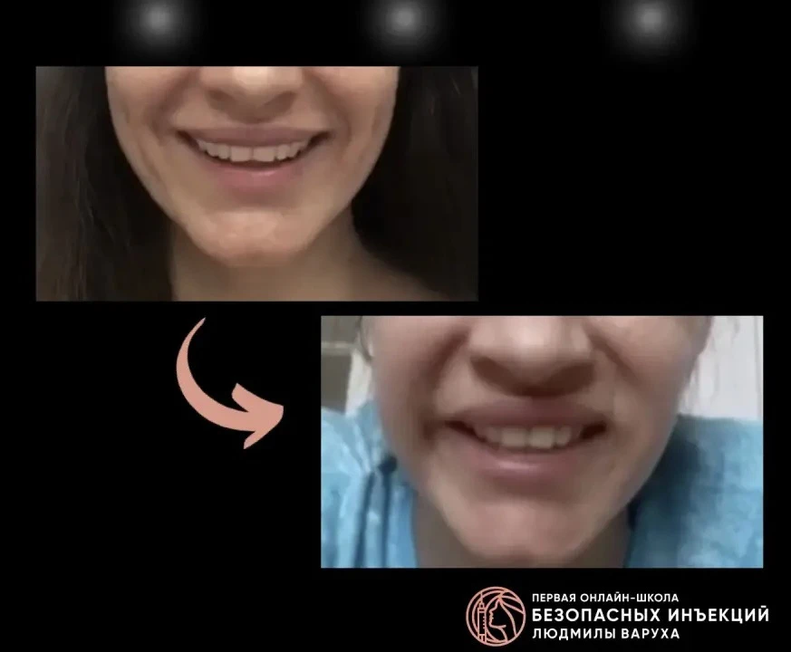 ❌БЛОК УЛЫБКИ после БТА

Коллеги, всем добрый день! 

Если у пациента развивается осложнение в виде Б