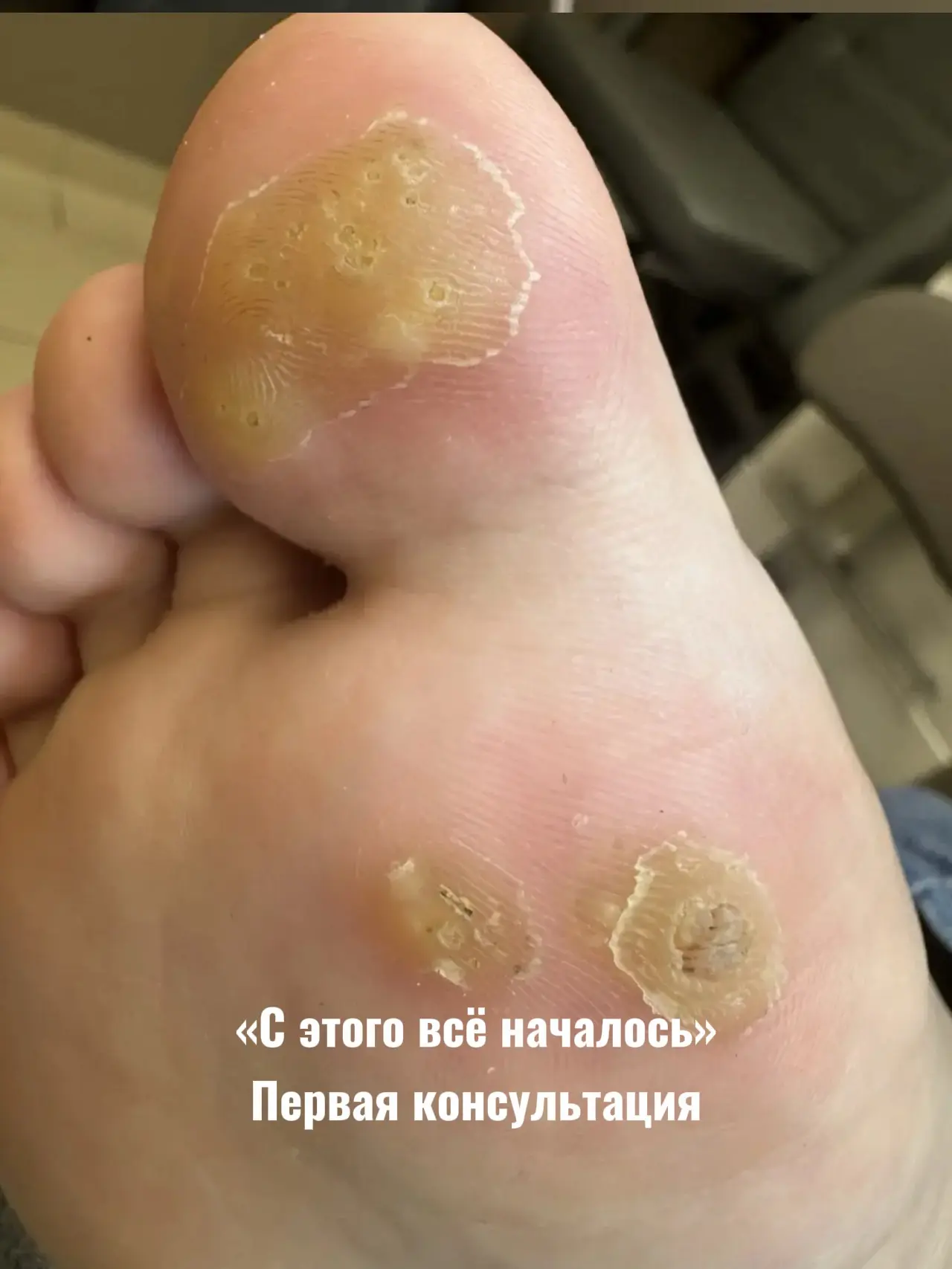 Недавно я посмотрела на эту стопу, а смотреть уже не на что , бородавок больше нет.