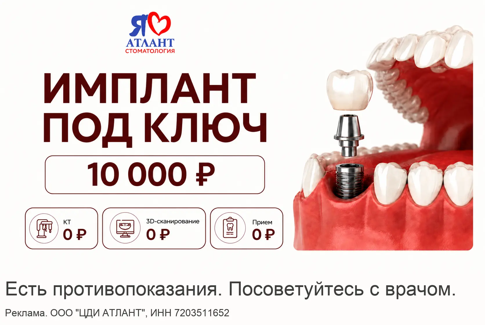 Имплант под ключ 10 000₽ в Тюмени