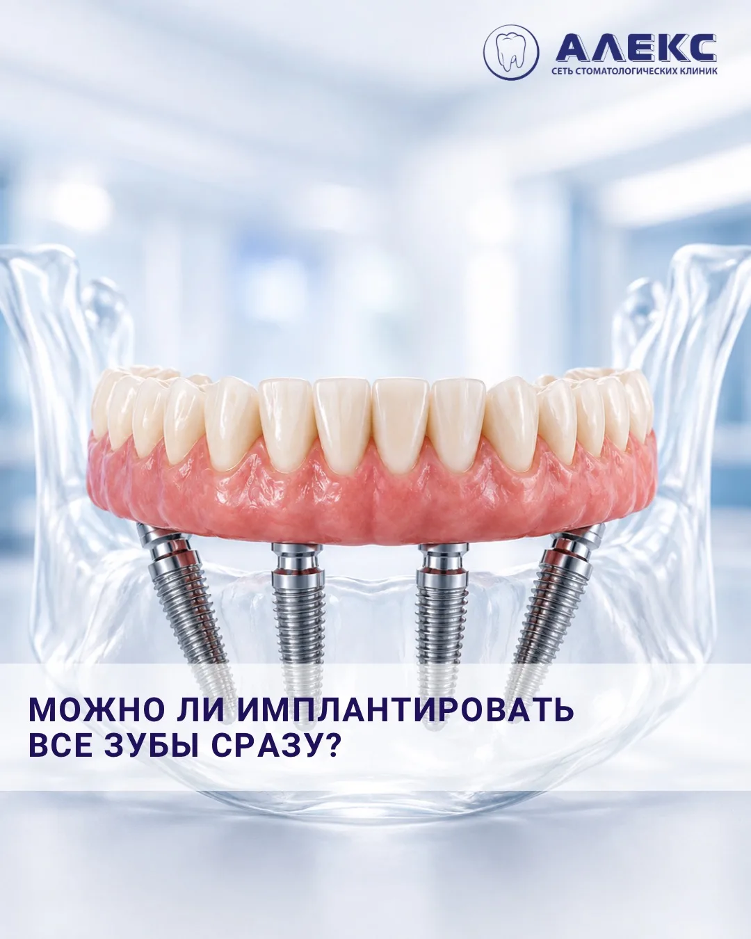 А что, если имплантировать все зубы сразу?