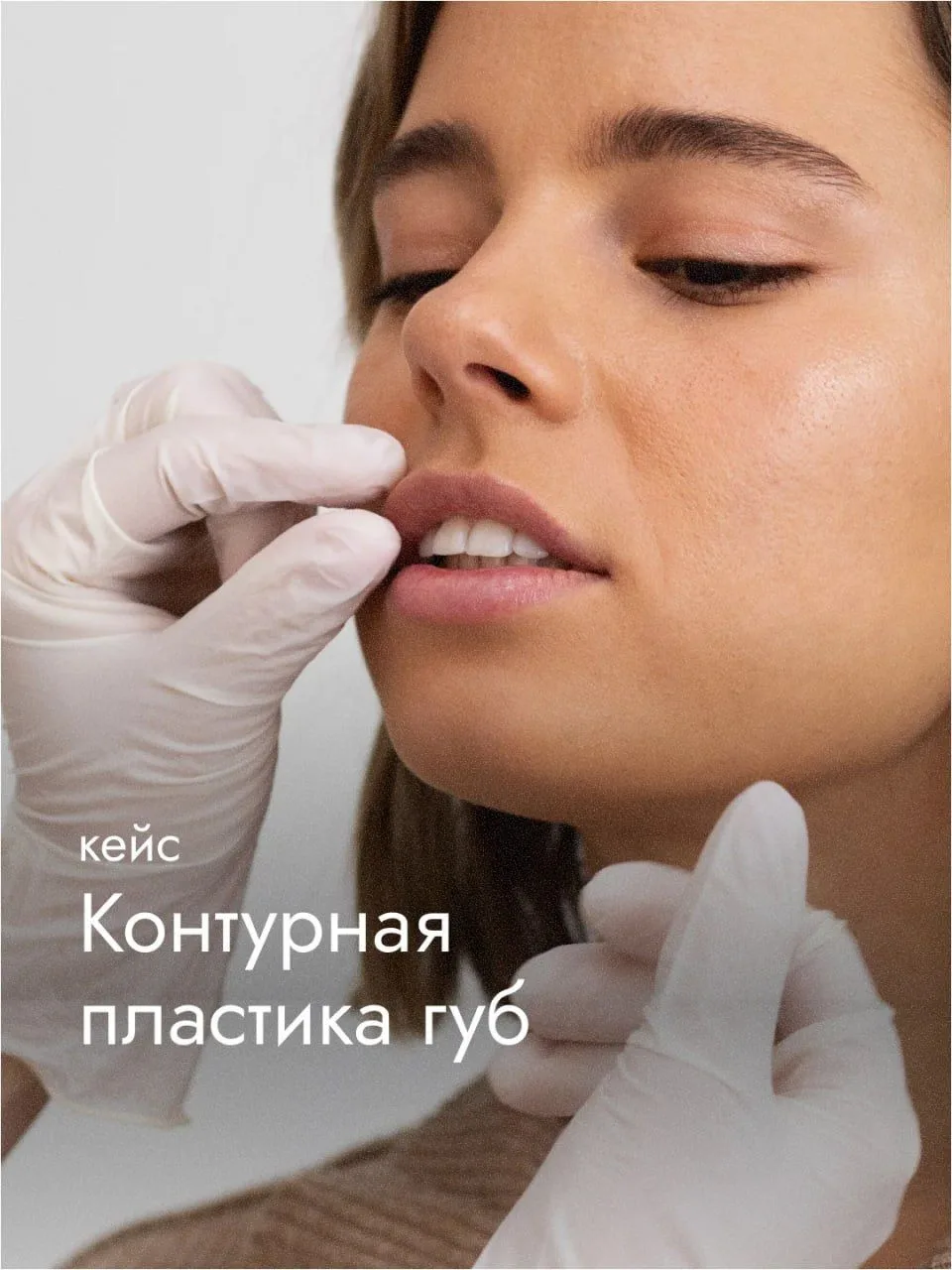 Кейс: контурная пластика — появился естественный объём губ
