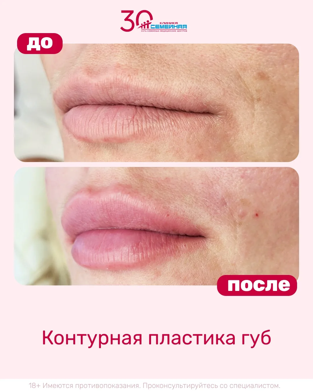 👄 Результат контурной пластики губ