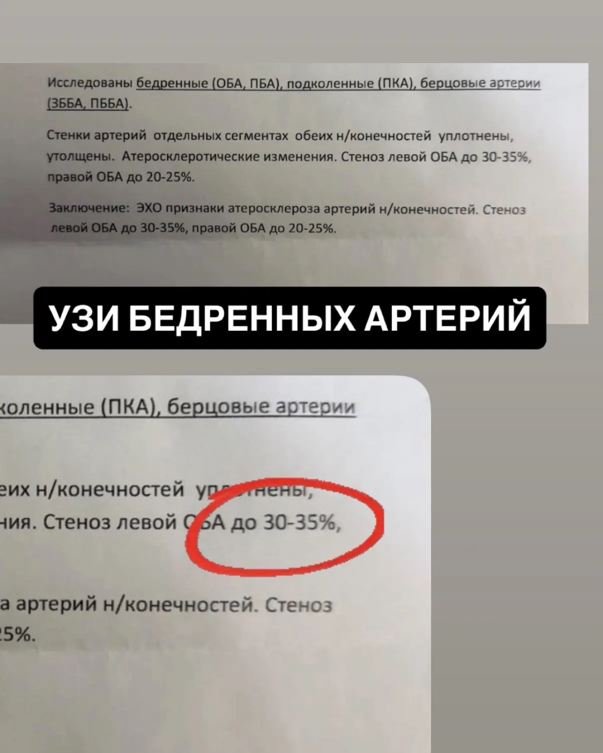 Делает УЗИ бедренных артерий…. 

Приплыли! 54 года… бляшки 35%. 

И конечно это статины! Да, я приме