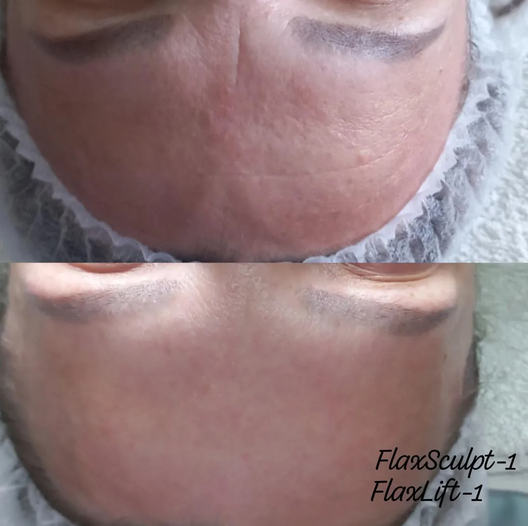 Сделана 1 процедура Flax Sculpt