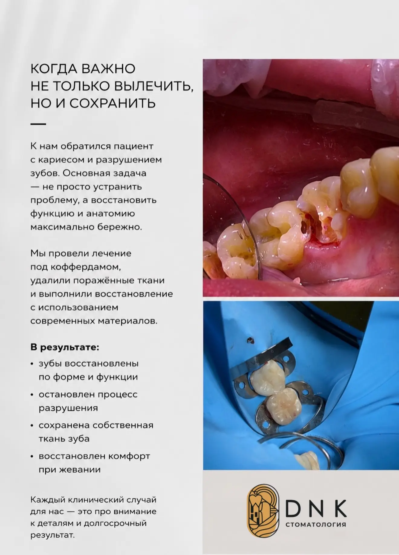 Сохранить зуб всегда лучше, чем заменить его. 🦷