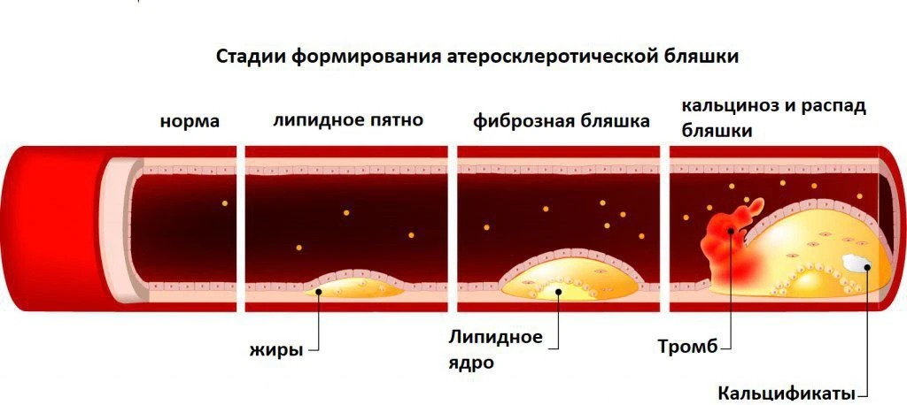 Чистим сосуды  Сегодня, во времена развития фастфуда и, в целом, рафинированного питания проблема за