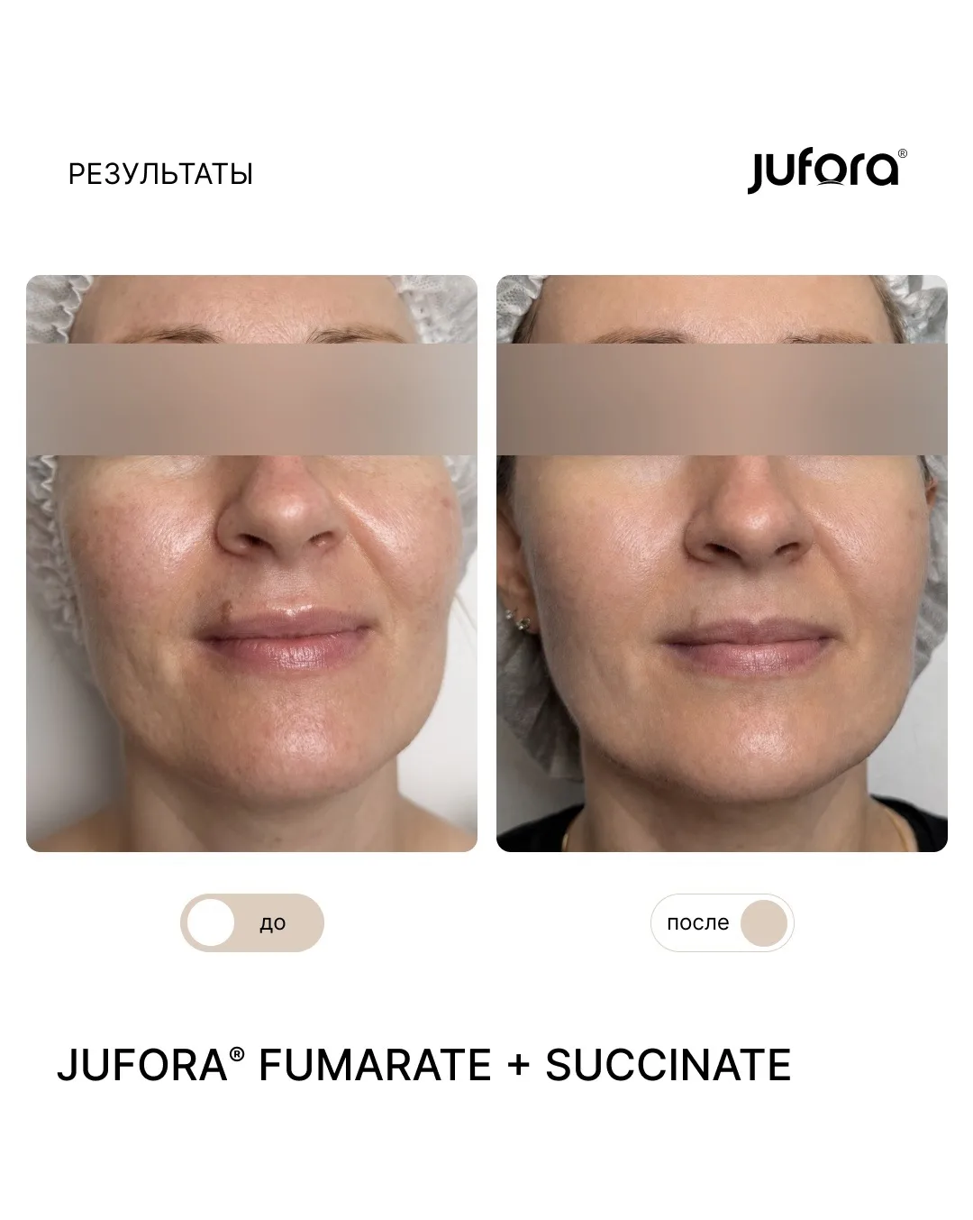 💉 Результат курса препаратом JUFORA FUMARATE + SUCCINATE
