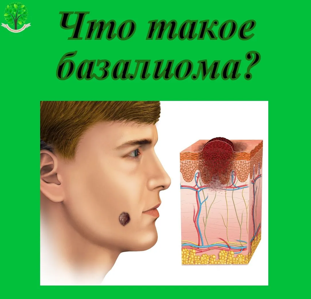 ✅БАЗАЛИОМА (базальноклеточный рак кожи) — злокачественное новообразование, которое разв...