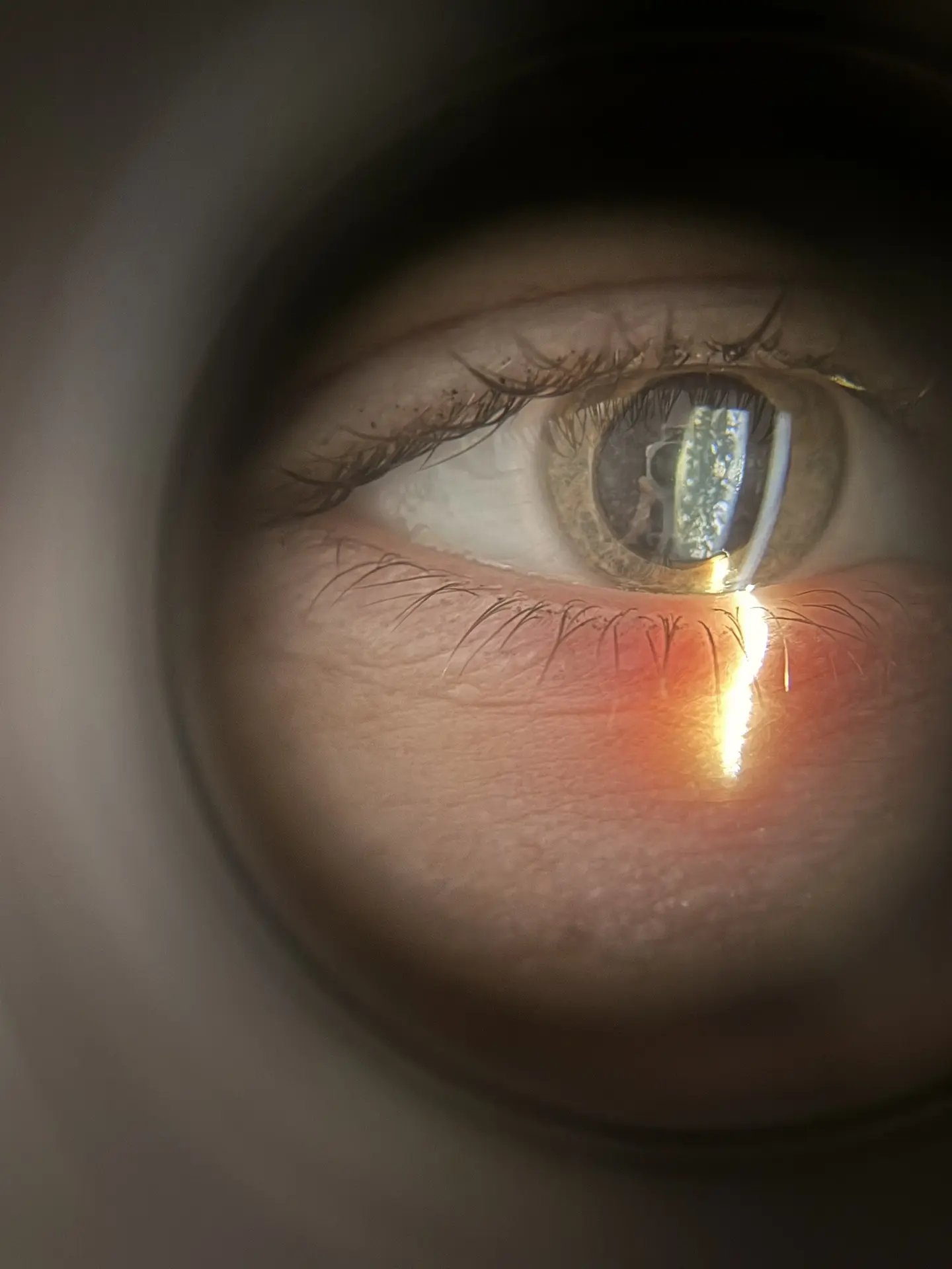 👁 Когда очки не помогают