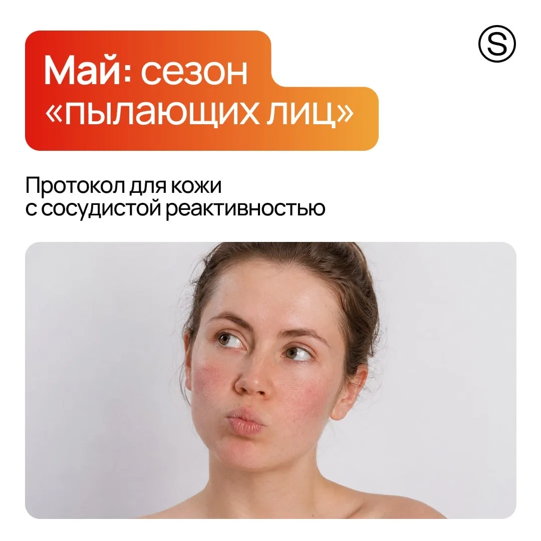 Май — официальный старт сезона обострений у клиентов с куперозом и ранними проявлениями...