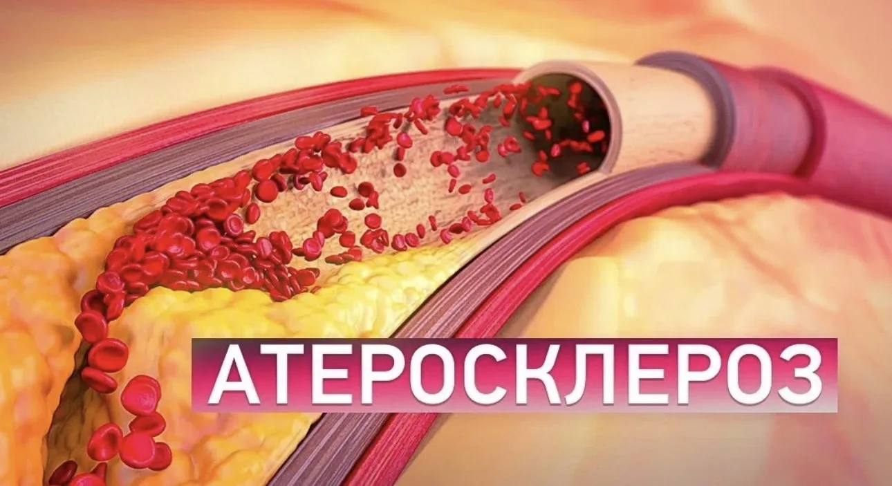 Атеросклероз - единственная болезнь , первым симптомом которой может быть ИНФАРКТ или И...