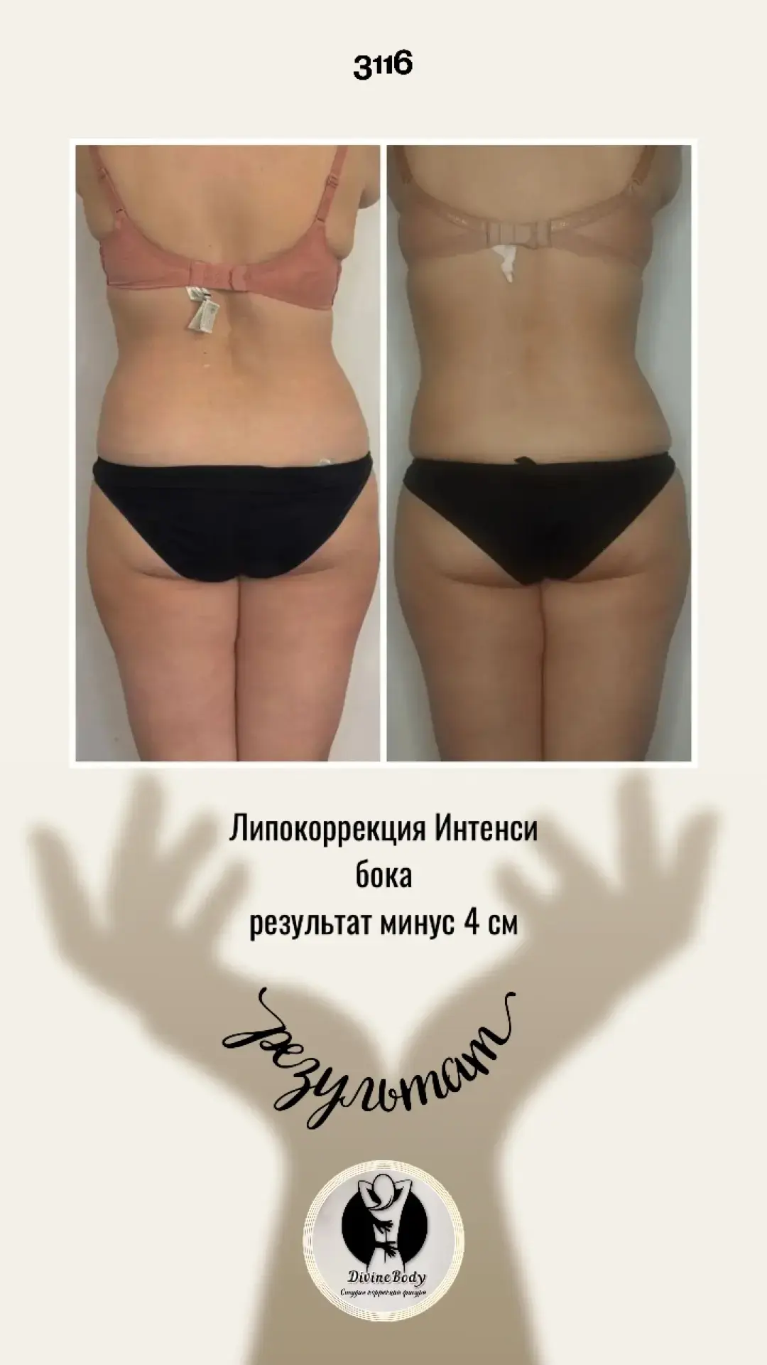 ✨ Минус 4 см без операций

Результат курса ручной липокоррекции Интенсив. Зона бока👇

— более чётки
