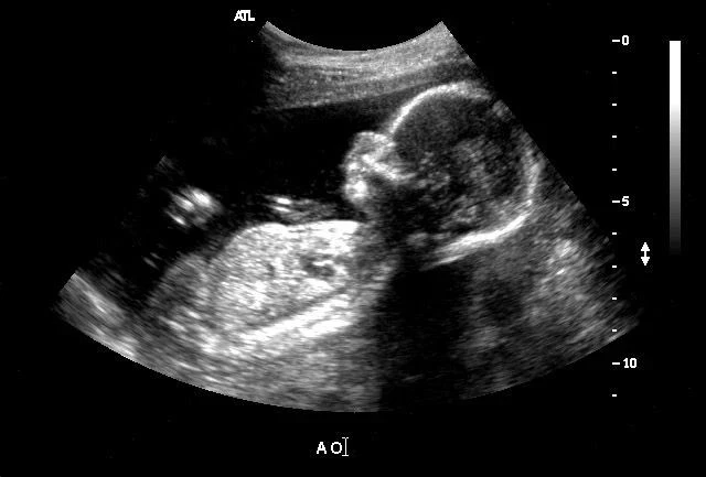 👶 Заячью губу у ребенка можно увидеть еще во время беременности?