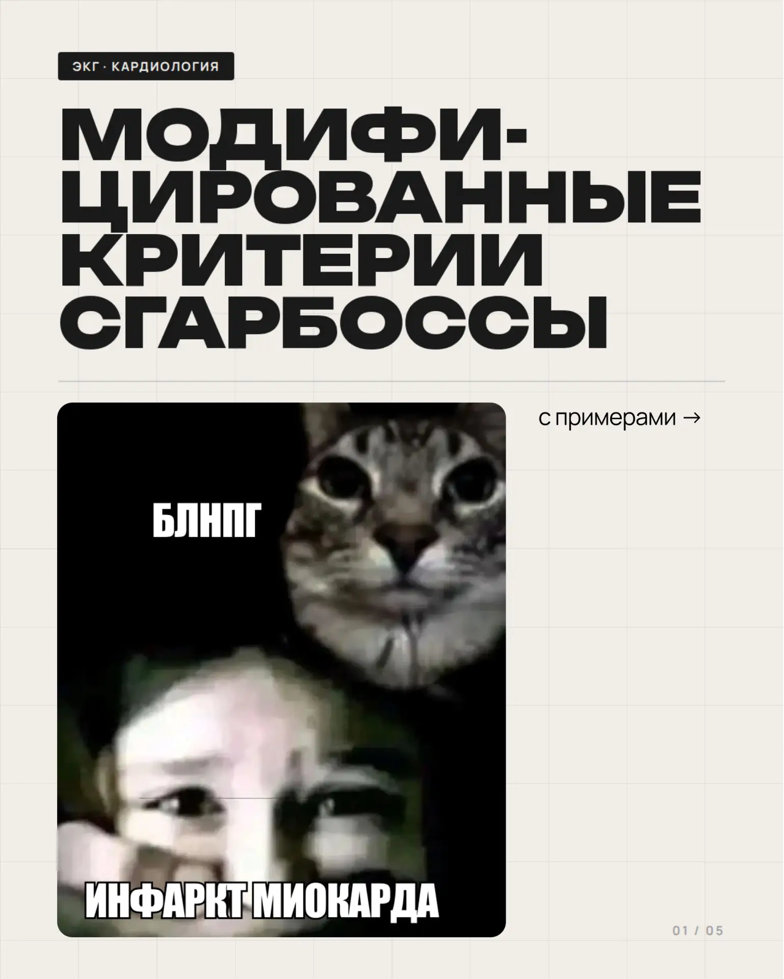 🤨 Тут инфаркт или нет? Как понять?

Модифицированные критерии Сгарбоссы с примерами ловим и сохраня