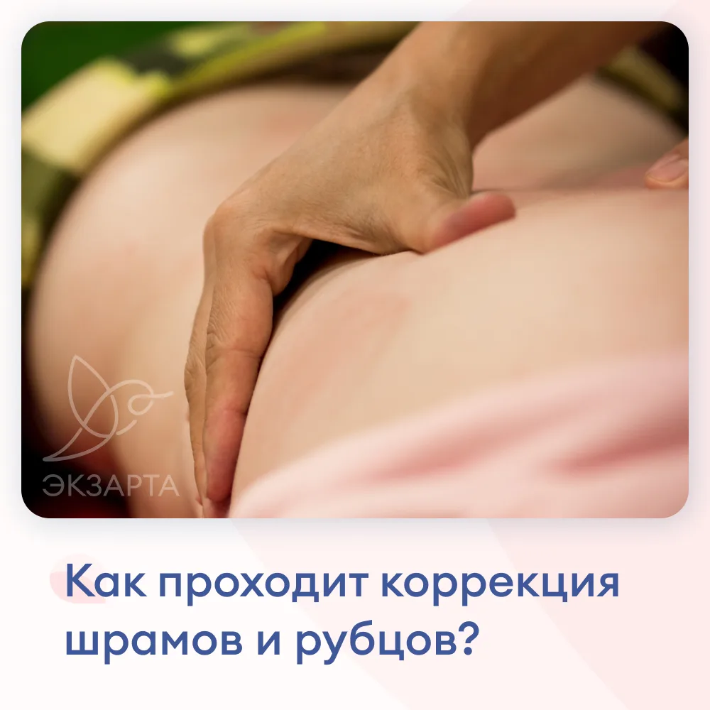 Как проходит коррекция шрамов и рубцов?