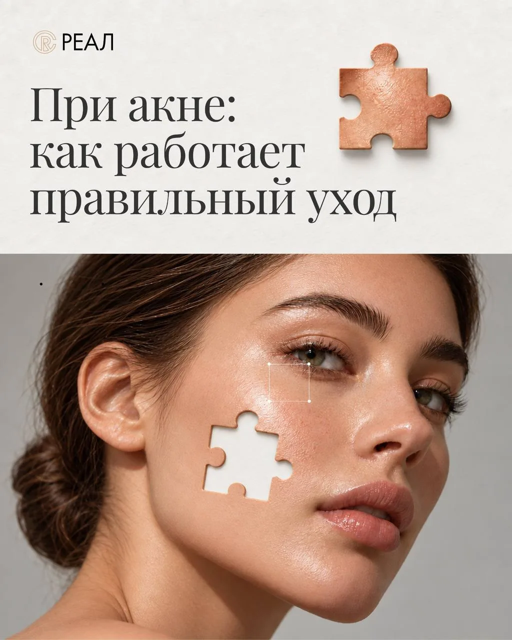 Чистая кожа: кейс лечения акне в клинике Реал.