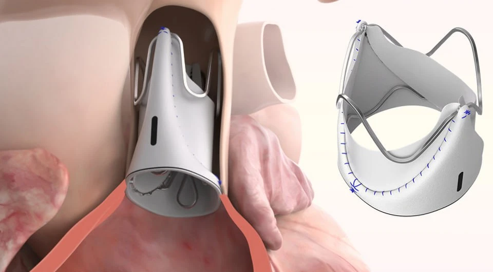 FDA одобрило хирургически имплантируемый клапан лёгочной артерии для детей с врождённым...