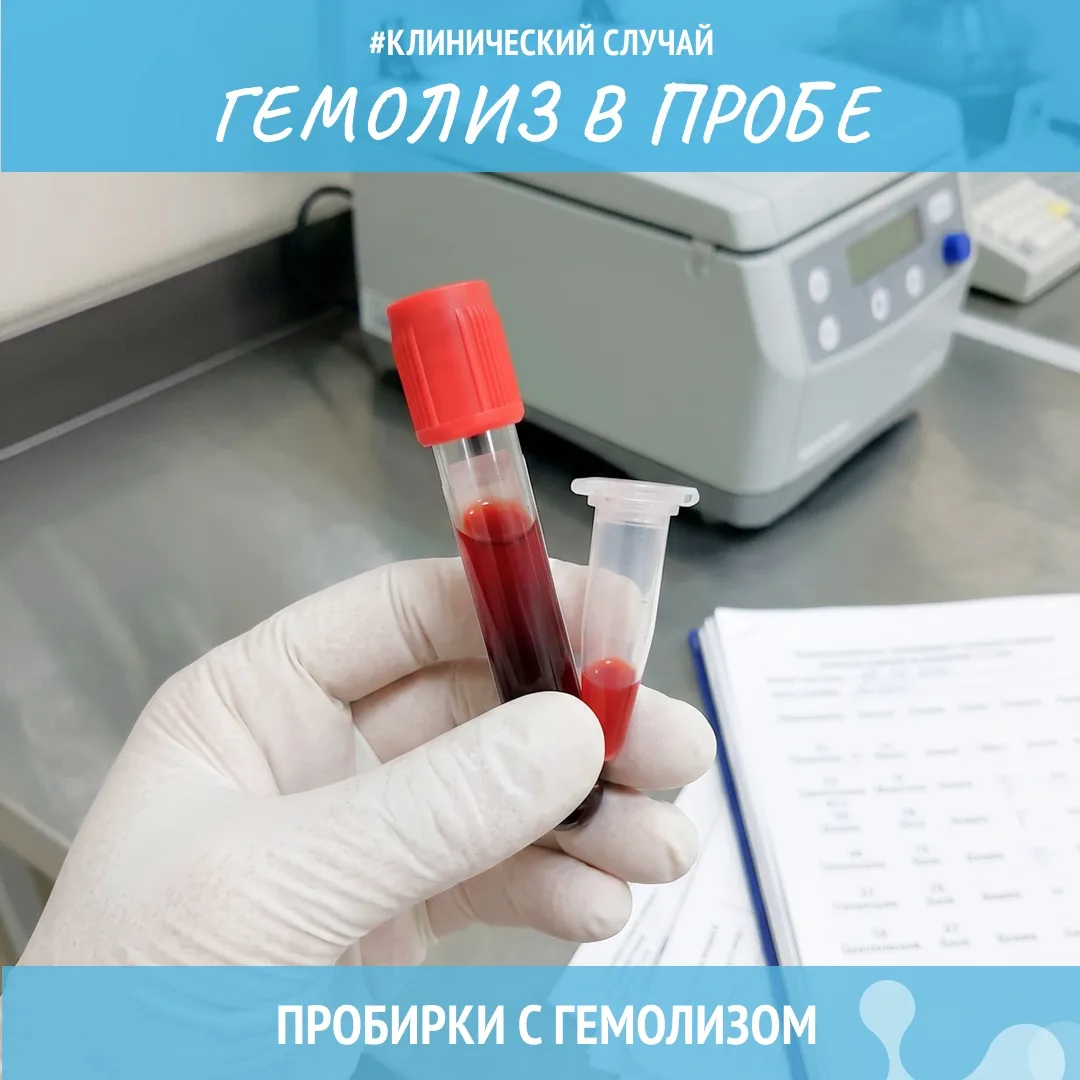#преаналитика