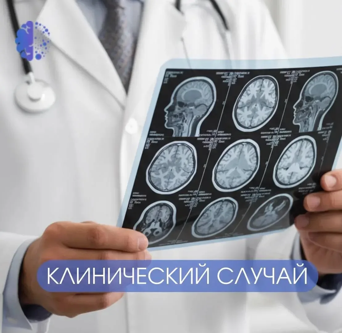 ❔Очаги есть, а рассеянного склероза нет