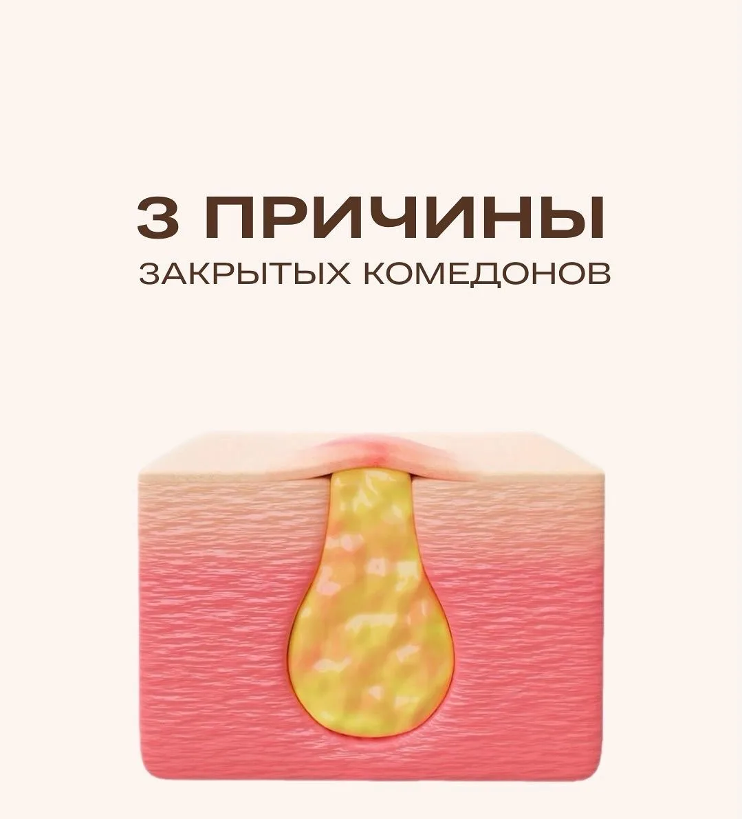 3 малоизвестные причины закрытых комедонов

Многие винят только жирную кожу и плохое очищение. Но пр