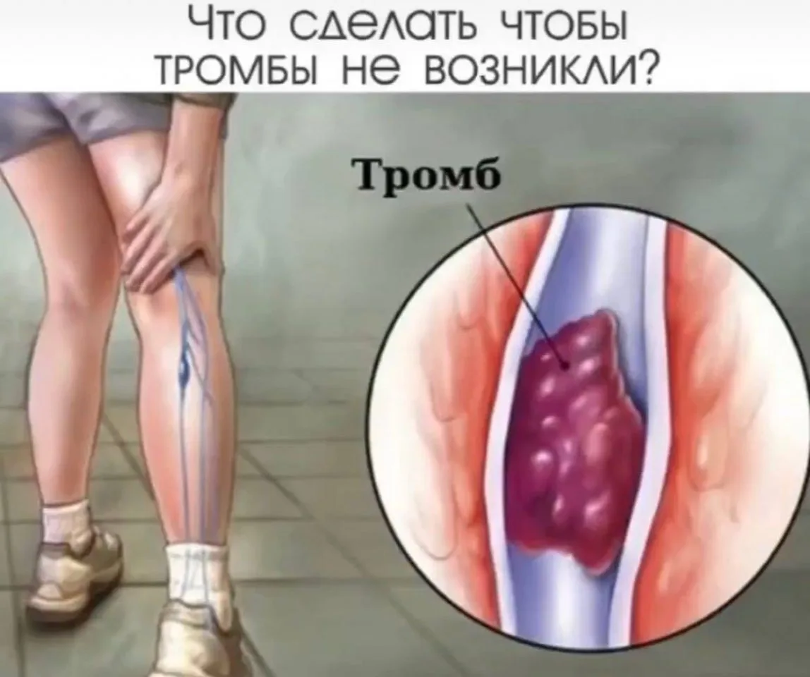 Что сделать чтобы тромбы не возникли?