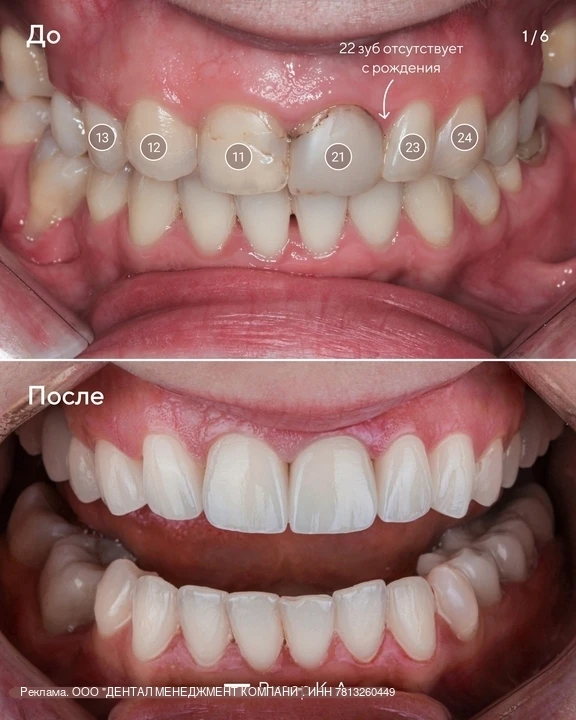 Что делать, если одного из передних зубов нет с рождения? 🦷