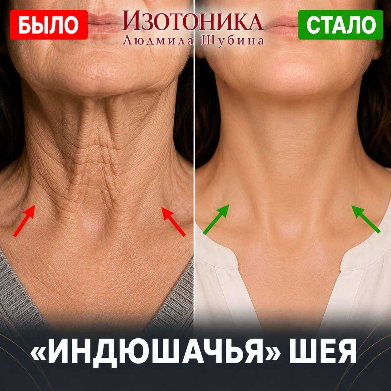 Отчего появляется «индюшачья» шея? Вы смотрите в зеркало и видите: под подбородком кожа...