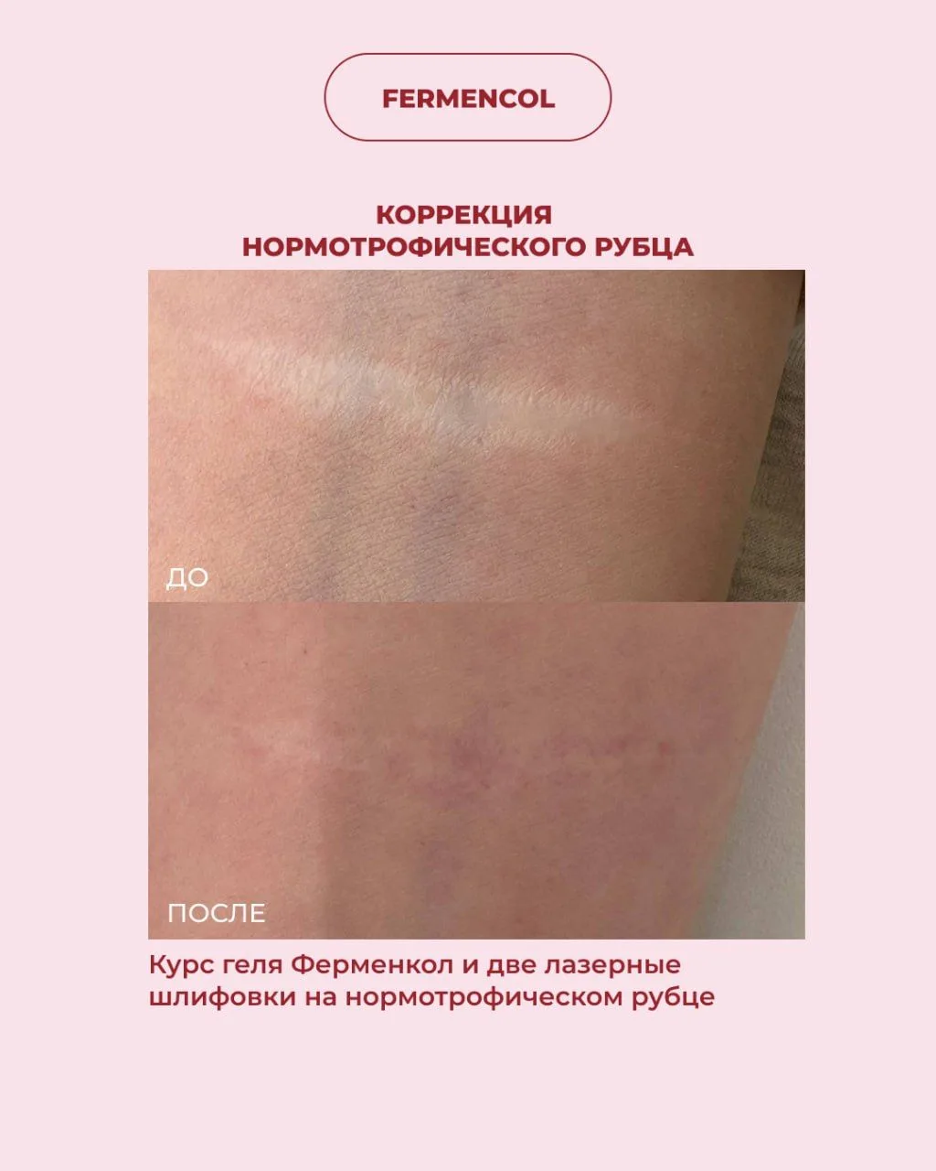 ✅Нас часто спрашивают, можно применять Ферменкол на нормотрофических рубцах?