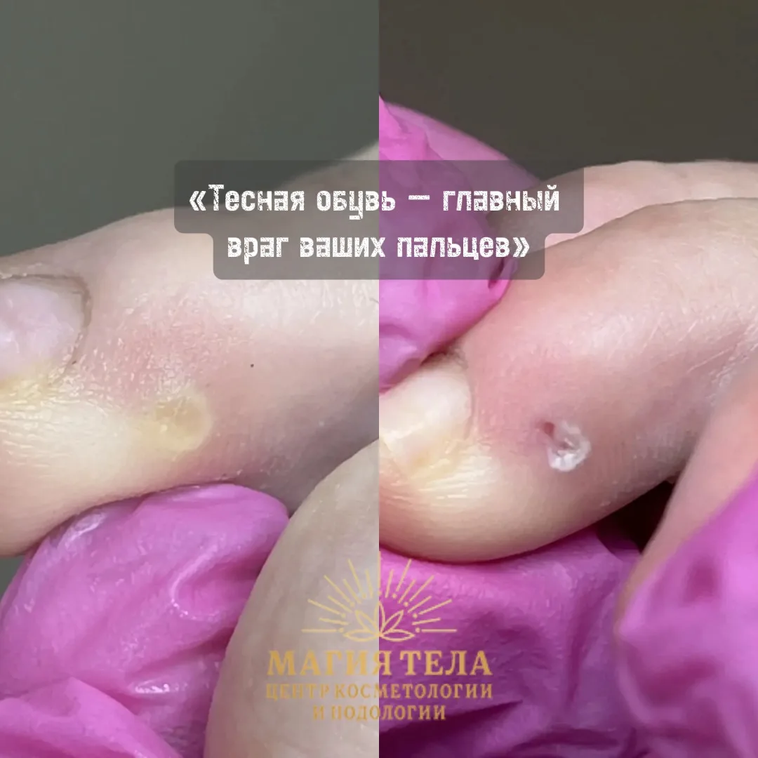 👟 «Тесная обувь — главный враг ваших пальцев»