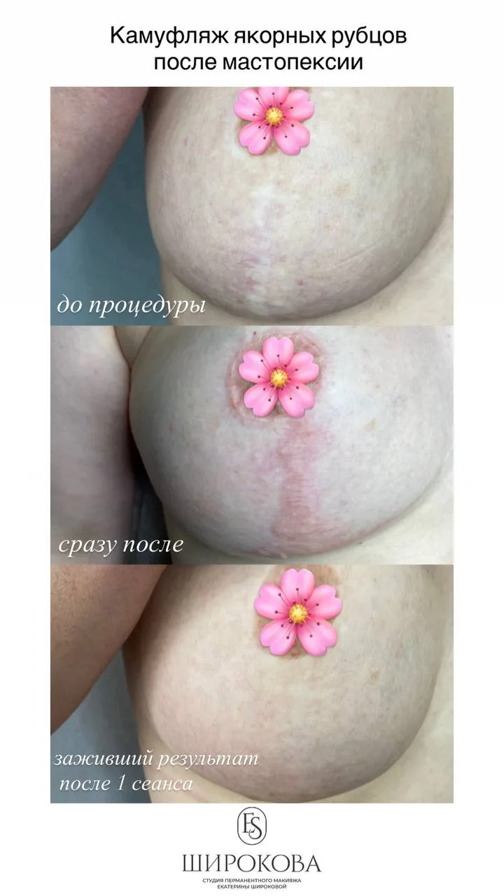 Камуфляж рубцов после подтяжки груди 🤍