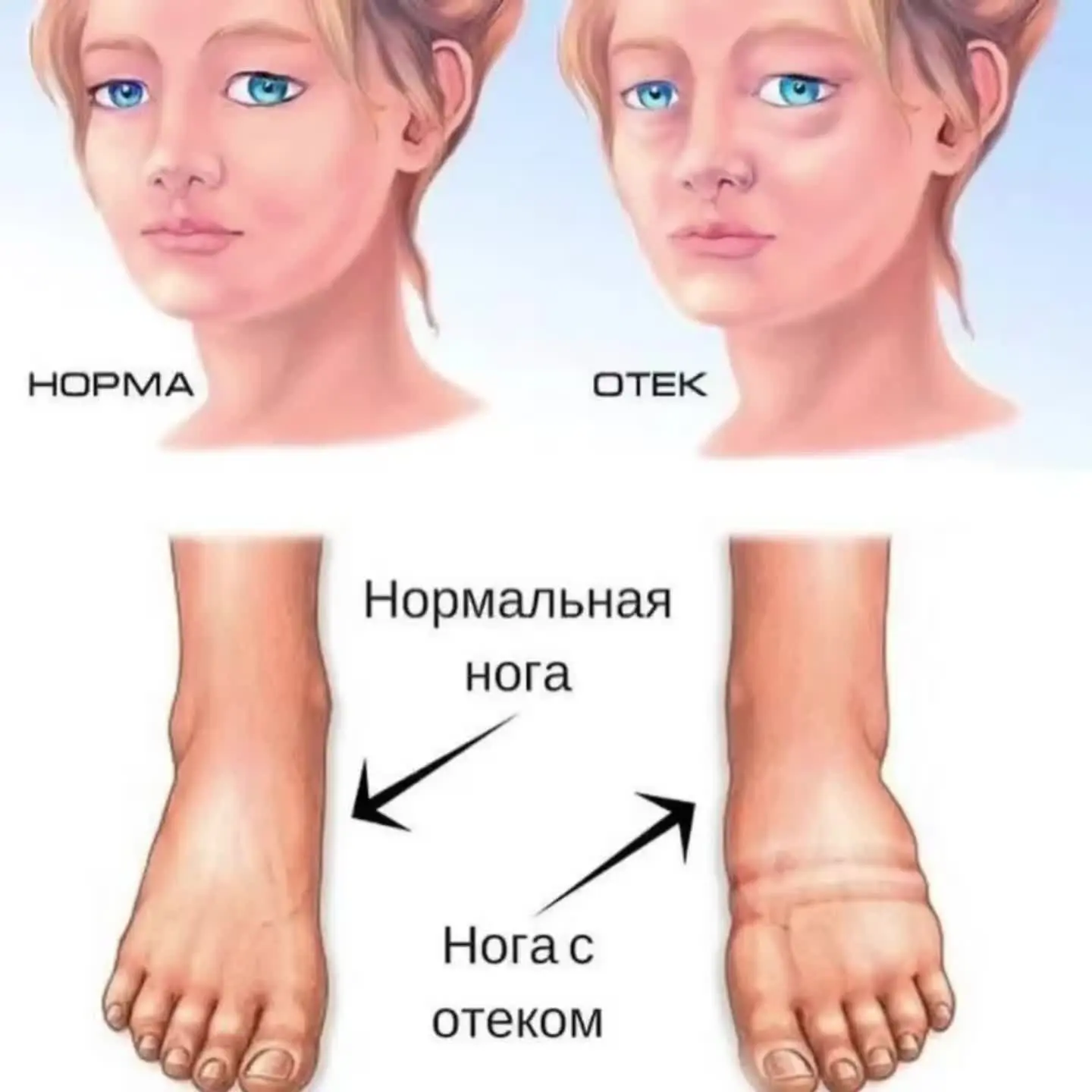 РАЗБИРАЕМСЯ В ПРИЧИНАХ ОТЕКОВ