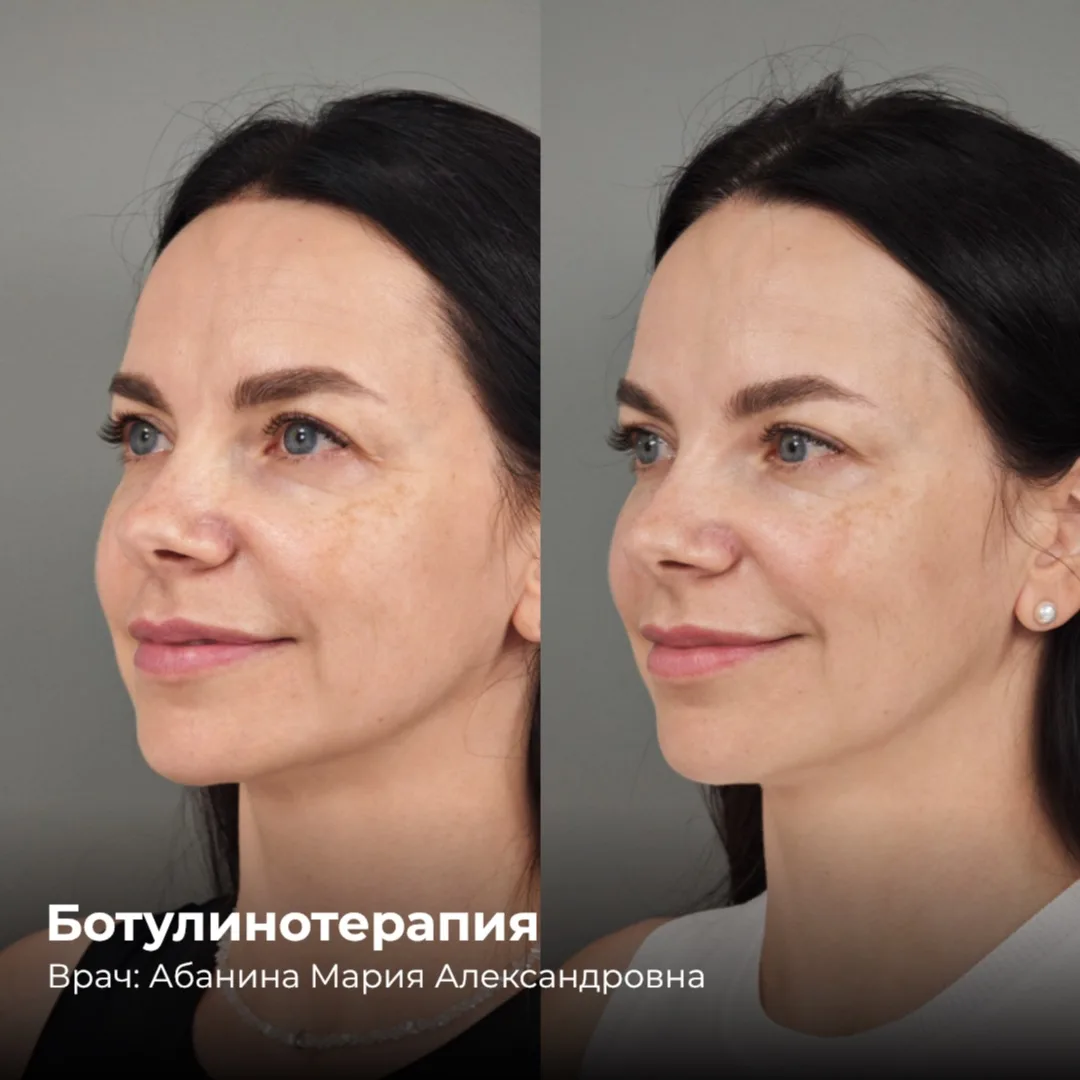 Full Face ботулинотерапия — одна из эффективных методик, потому что она позволяет работ...
