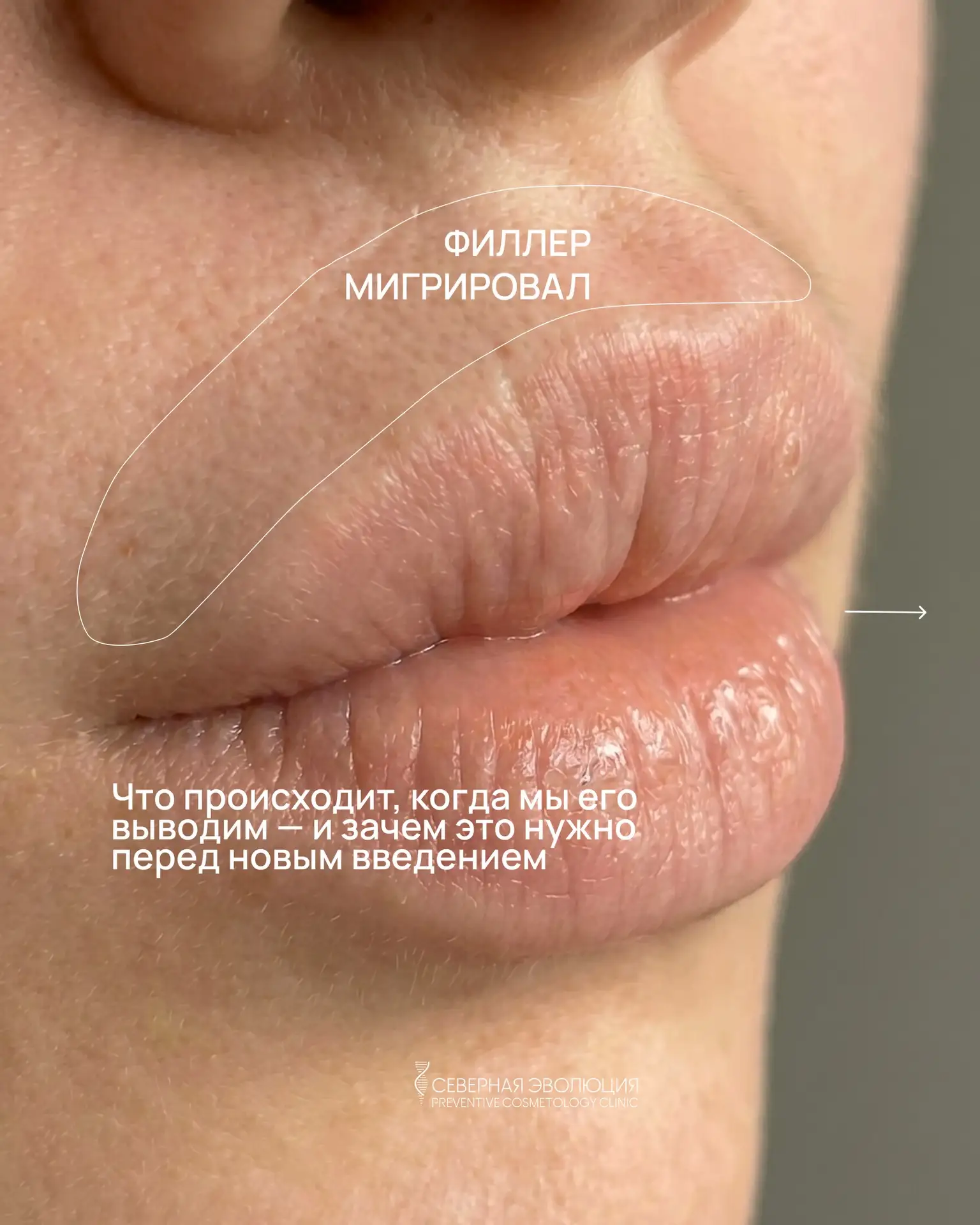 💉Разобрали в карусели, почему филлер мигрирует и как мы с этим работаем.

Ниже — то, о чём спрашива