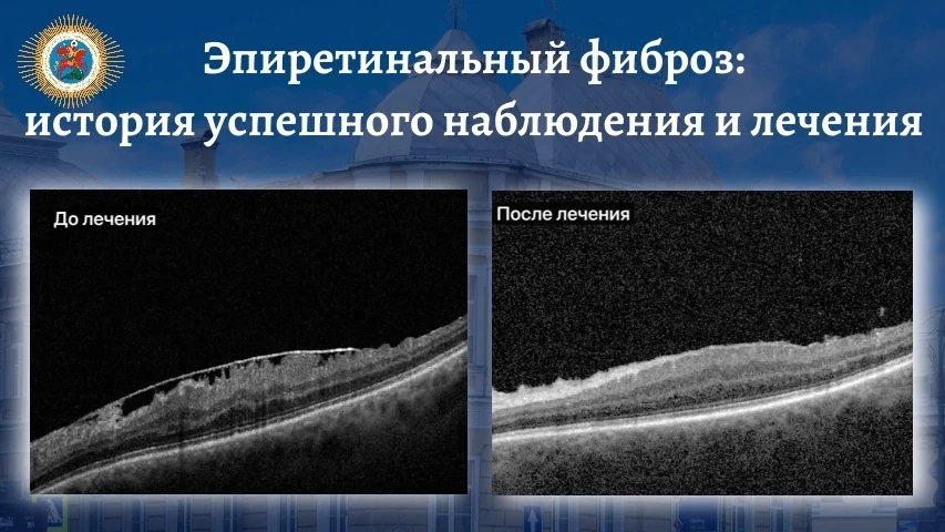 ⚡ Эпиретинальный фиброз: история успешного наблюдения и лечения 

✅ На консультацию в НМИЦ глазных б