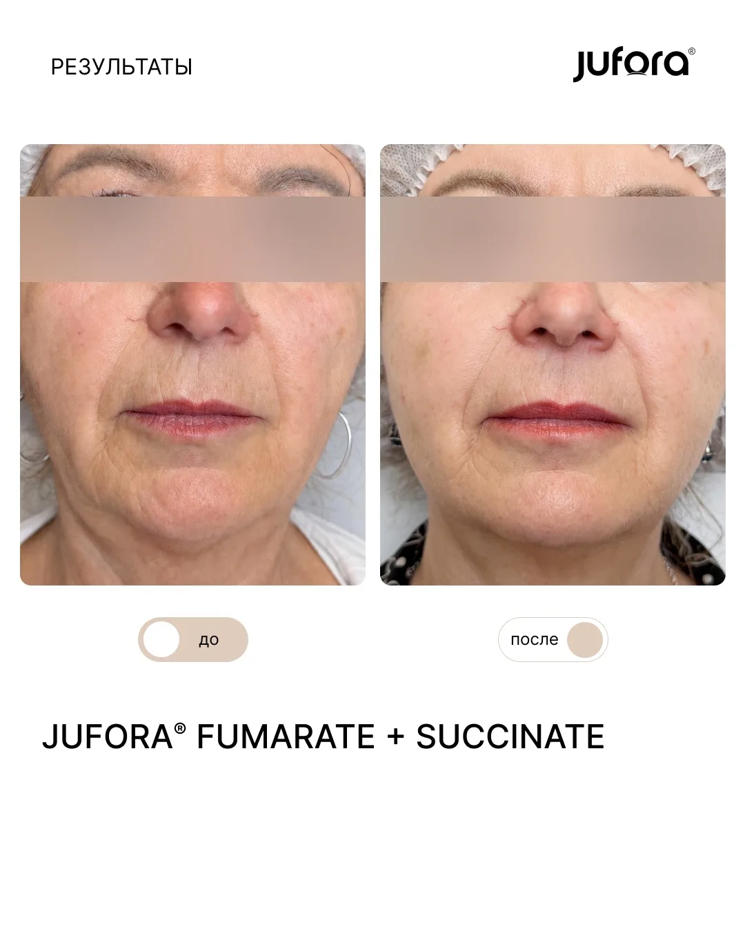 Результат курса с JUFORA FUMARATE + SUCCINATE 💉