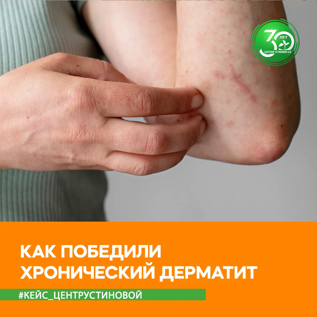 КАК ПОБЕДИЛИ ХРОНИЧЕСКИЙ ДЕРМАТИТ