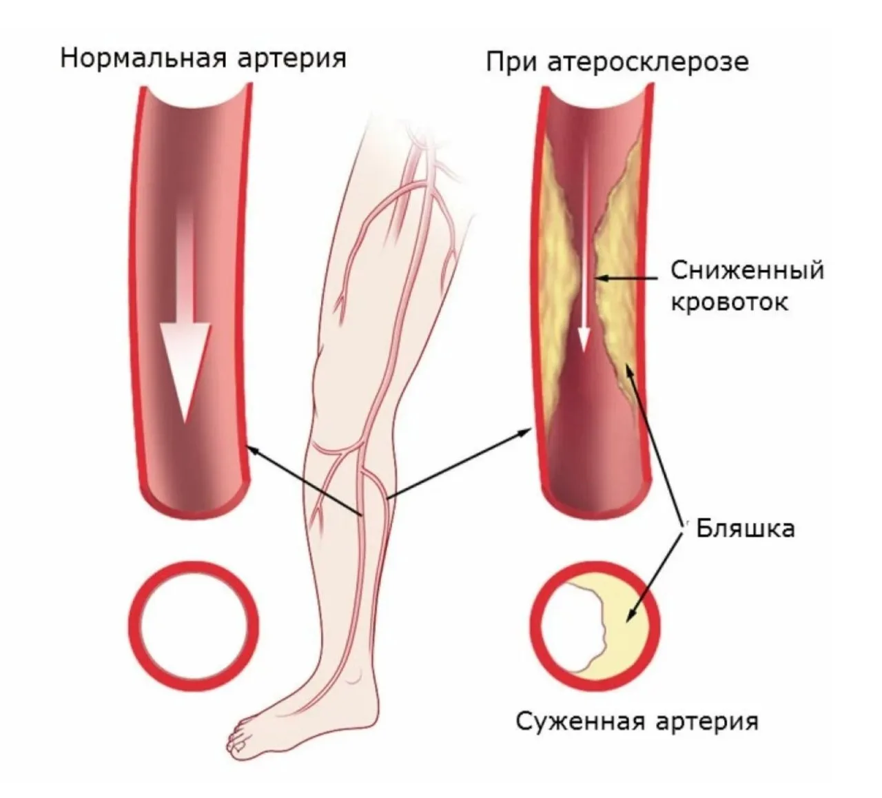 Боль в ногах при ходьбе может быть не просто усталостью, а первым сигналом атеросклероз...