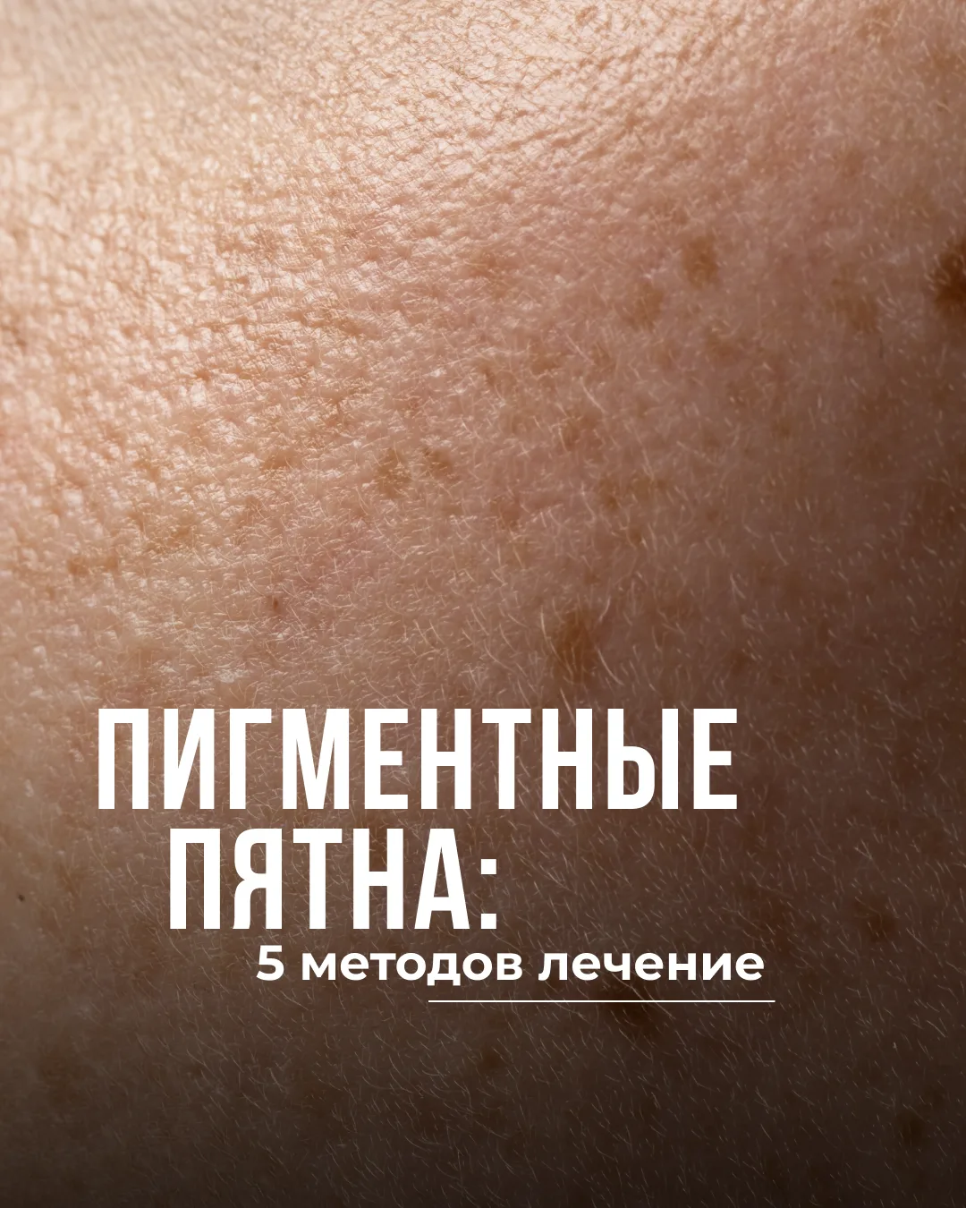 Пигментные пятна — это участки кожи, которые темнеют из-за избытка меланина. С теми или...