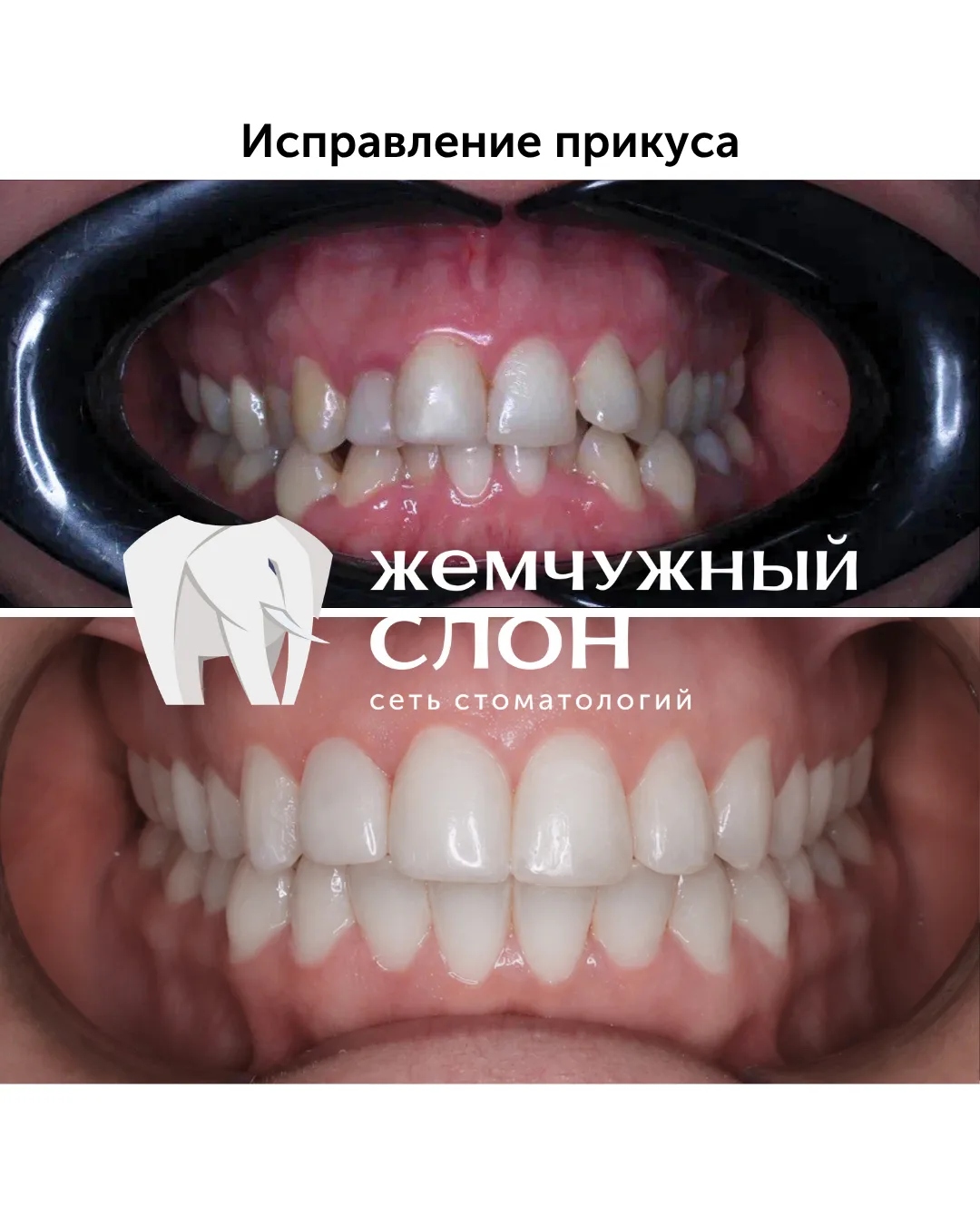 Работа команды специалистов филиала сети "Жемчужный слон" на Масленникова, 39.
Ортодонтическое лечен