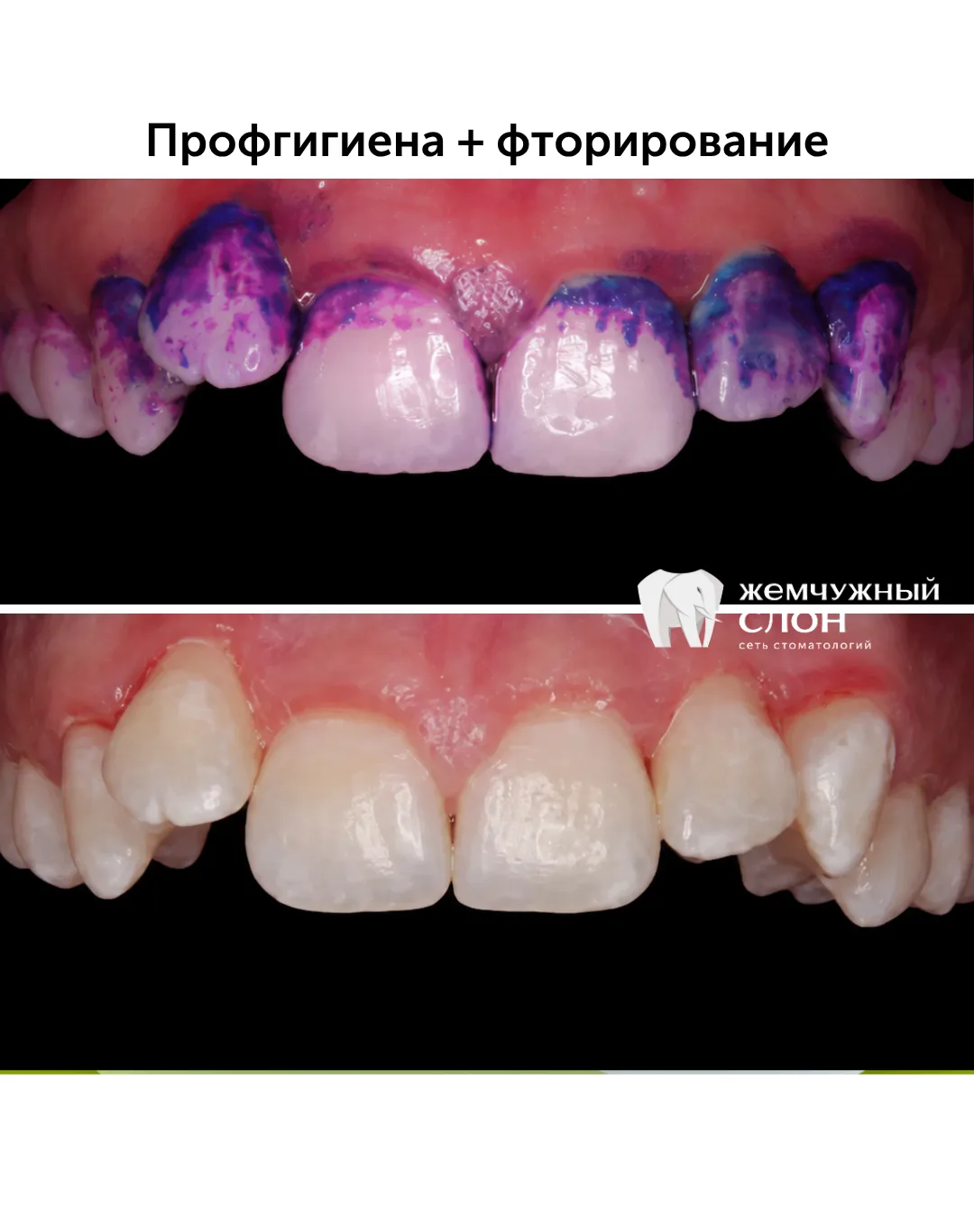 На фото хорошо видно, сколько бактериального налёта может оставаться на зубах даже при ...