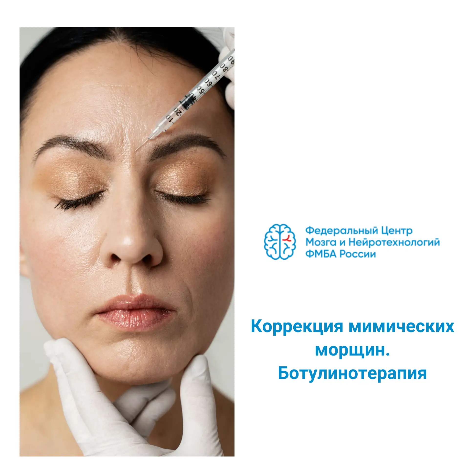 Мимические морщины формируются не только из-за возраста. На их выраженность влияют инди...